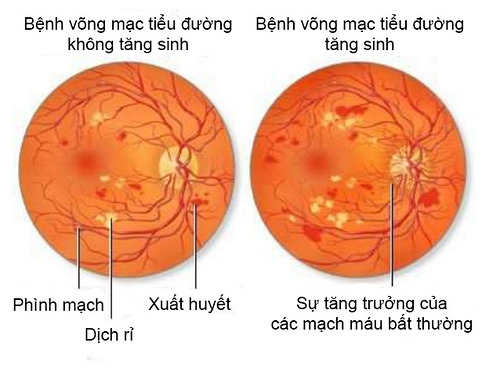 Retinopathy - Hình ảnh minh họa