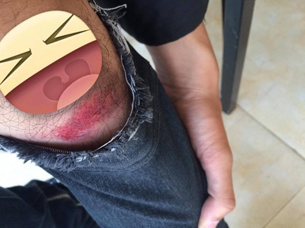 Rách đầu gối - Hình ảnh minh họa