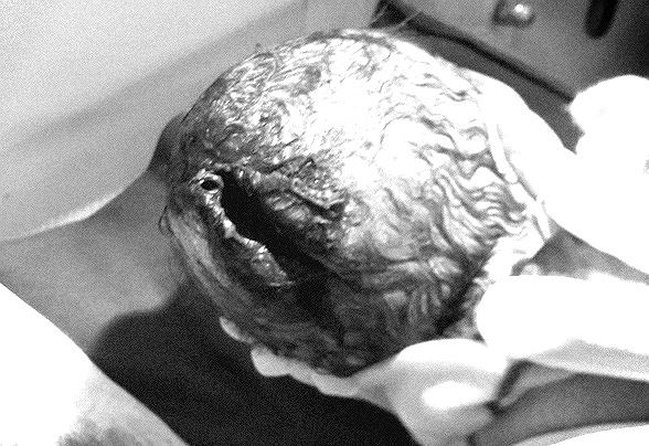 Rách da đầu - Hình ảnh minh họa