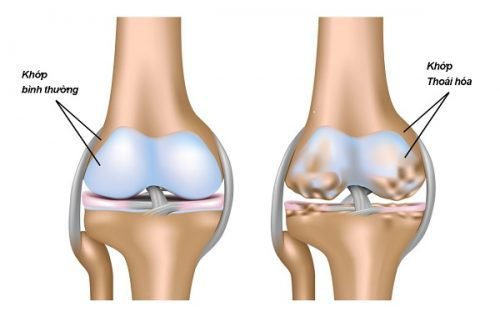 Các phương pháp điều trị thoái hóa khớp gối - ảnh 3