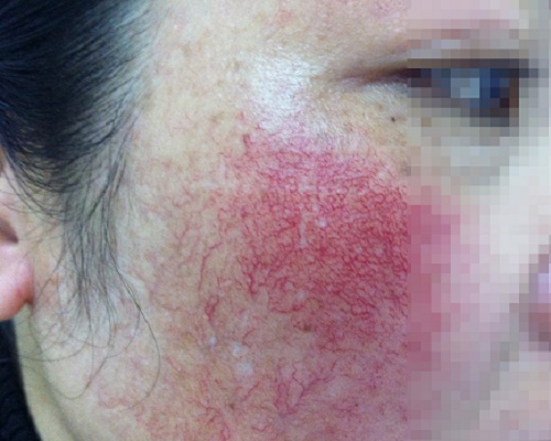 Sưng da - Hình ảnh minh họa