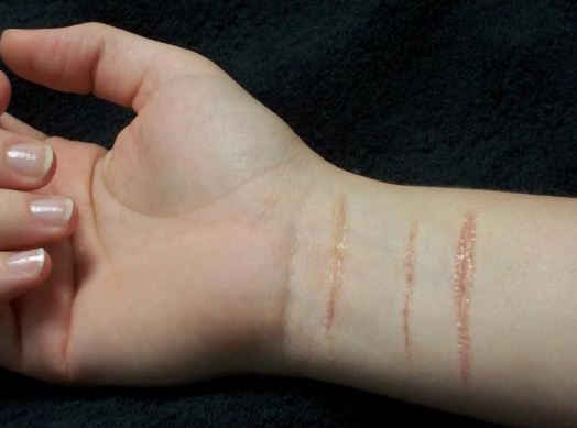 Sẹo - Hình ảnh minh họa