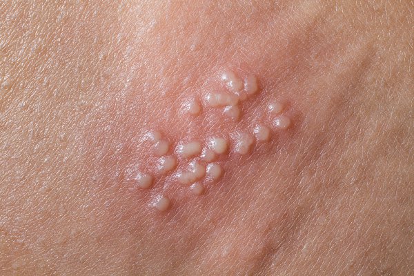 Những bệnh nào lây qua đường tình dục? - ảnh 1