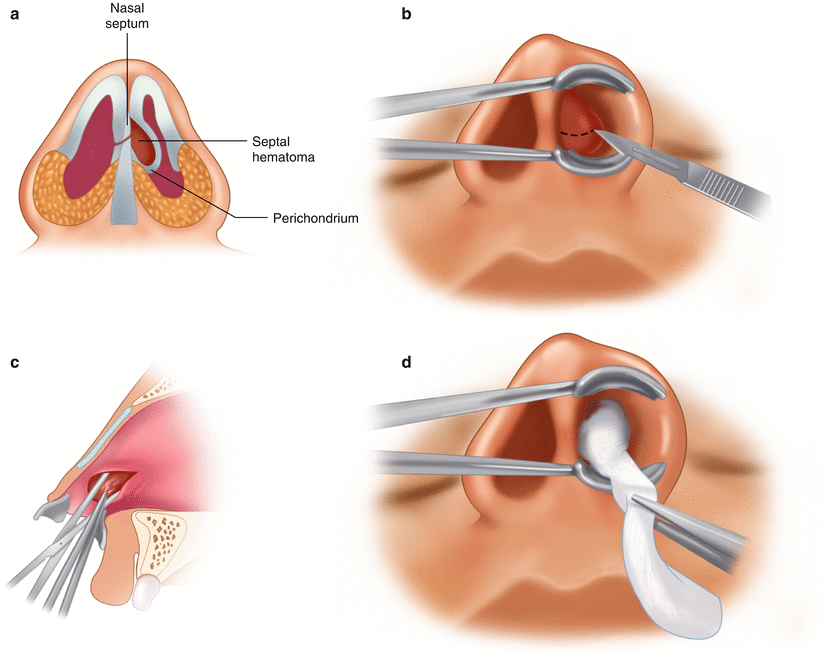 Septal hematoma - Hình ảnh minh họa