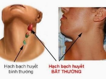 Sưng hạch bạch huyết - Hình ảnh minh họa