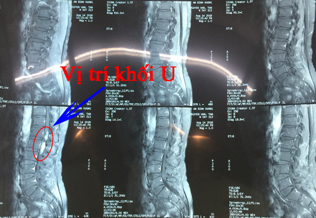 Spinal Cord Tumor - Hình ảnh minh họa