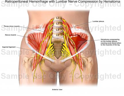 Retroperitoneal hemorrhage - Hình ảnh minh họa