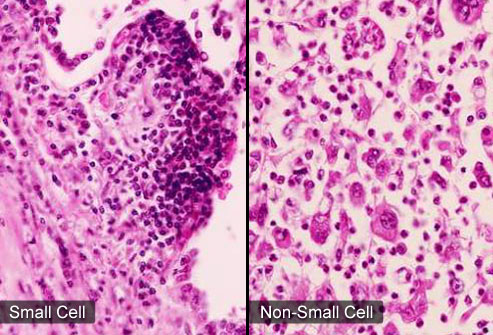 Small-cell Carcinoma - Hình ảnh minh họa