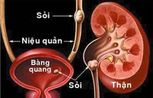 Sỏi niệu quản - Hình ảnh minh họa