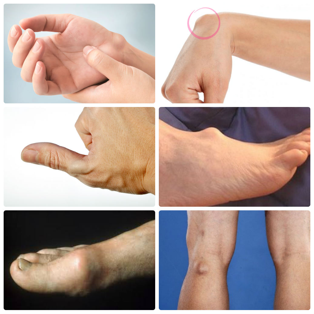 Synovial Cyst - Hình ảnh minh họa