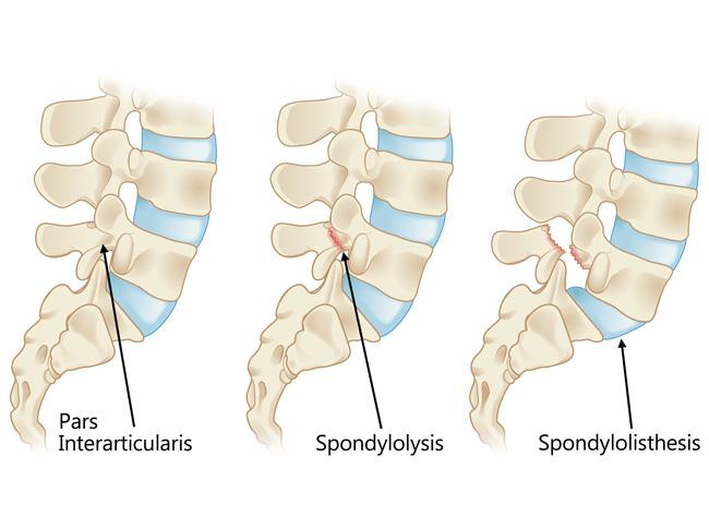 Spondylolisthesis - Hình ảnh minh họa