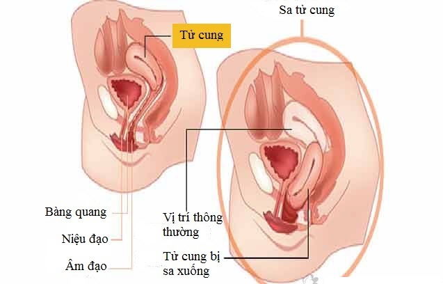 Sa tử cung - Hình ảnh minh họa