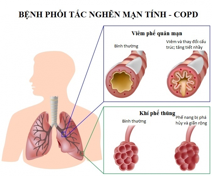 Suy hô hấp mạn - Hình ảnh minh họa