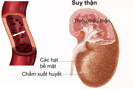 Suy thận mãn - Hình ảnh minh họa