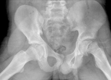 Slipped Capital Femoral Epiphysis - Hình ảnh minh họa