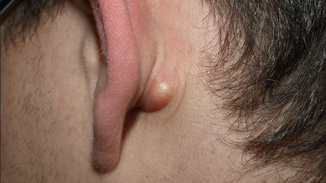 Sebaceous cyst - Hình ảnh minh họa