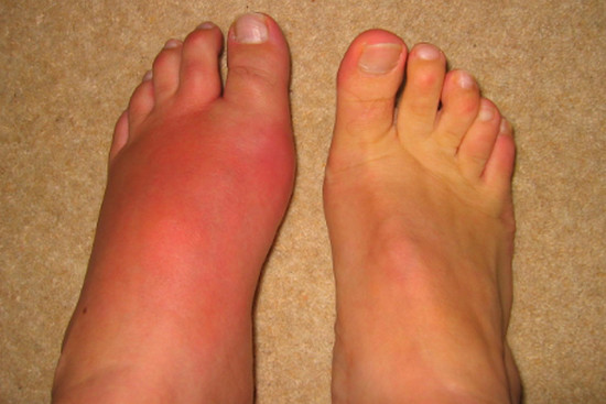 Sưng bàn chân - Hình ảnh minh họa