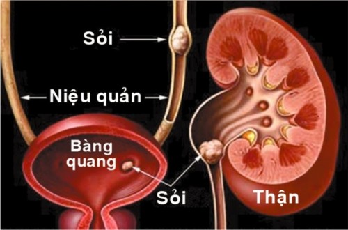 Sỏi bàng quang, tiết niệu - Hình ảnh minh họa