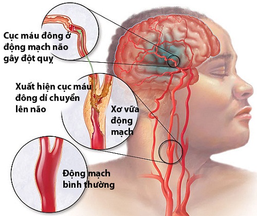 Stroke - Hình ảnh minh họa