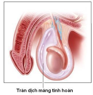 Tràn dịch màng tinh hoàn - Hình ảnh minh họa