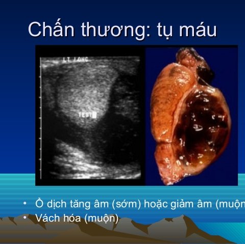 Tụ máu bìu - Hình ảnh minh họa