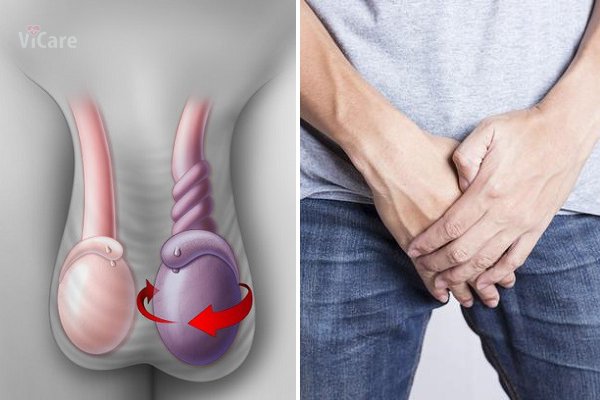 Testicular torsion - Hình ảnh minh họa