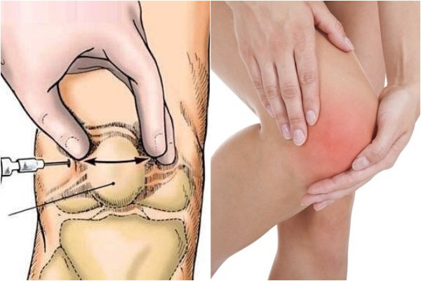 Tràn dịch khớp gối - Hình ảnh minh họa