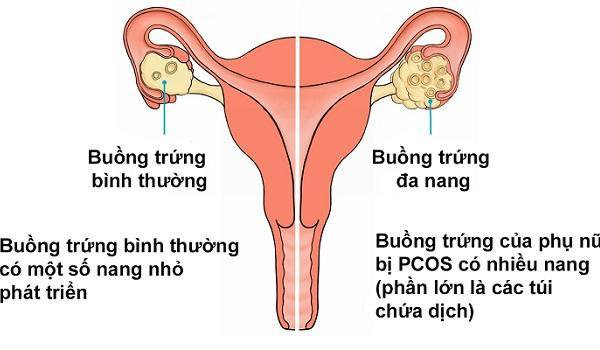 Bệnh Buồng trứng đa nang có con được không? - ảnh 1