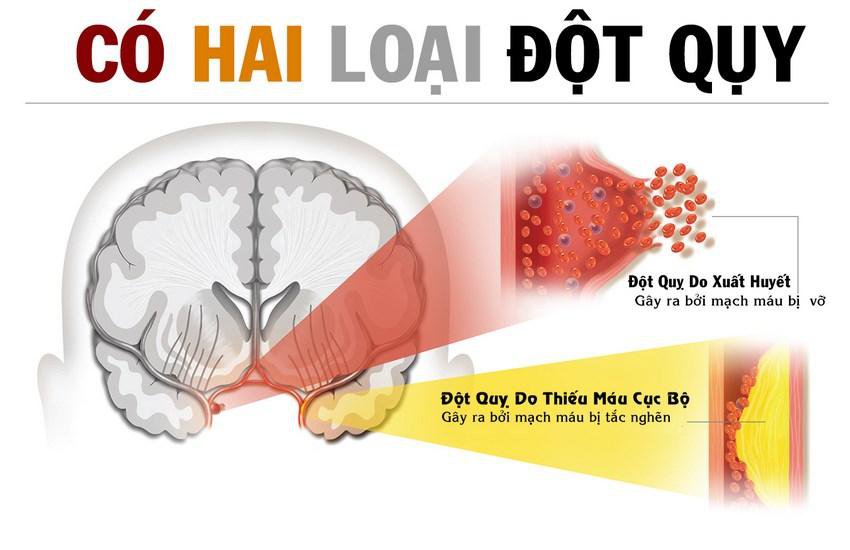 Đột quỵ não: Nguyên nhân, dấu hiệu nhận biết và Cách phòng tránh - ảnh 1