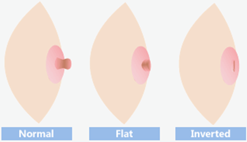 Núm vú bị tụt: nguyên nhân và Cách điều trị - ảnh 1