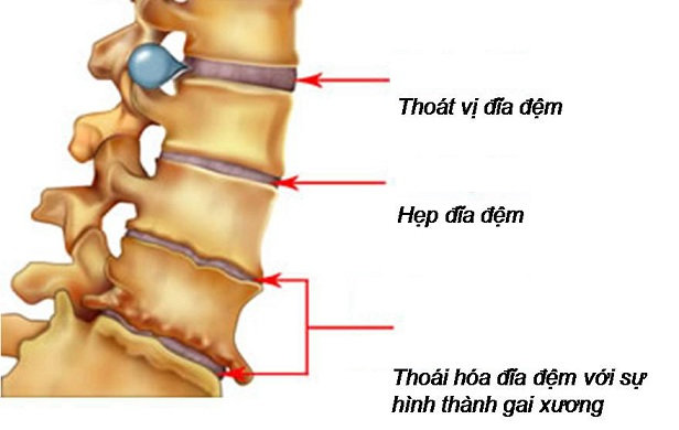Thoái hóa đĩa đệm - Hình ảnh minh họa
