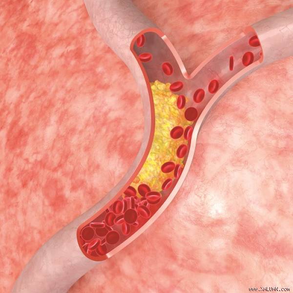 Tắc mạch máu do mỡ - Hình ảnh minh họa