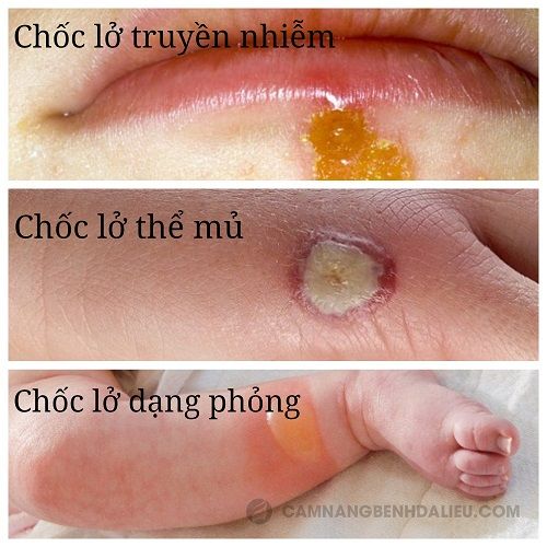 Chốc - Hình ảnh minh họa