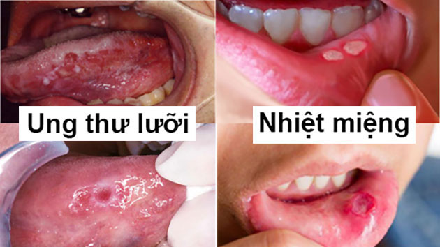 Tongue cancer - Hình ảnh minh họa