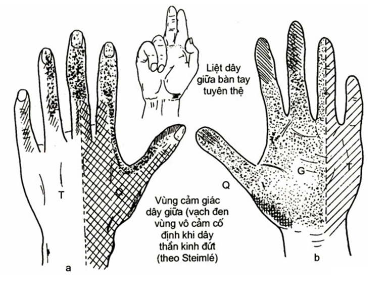 Tổn thương dây thần kinh do chấn thương - Hình ảnh minh họa