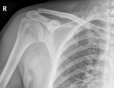 Trật khớp cùng đòn - Hình ảnh minh họa