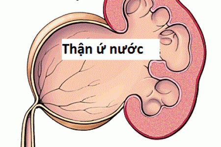 Thận ứ nước - Hình ảnh minh họa