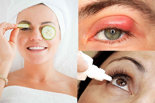 Sưng mí mẳt - Hình ảnh minh họa