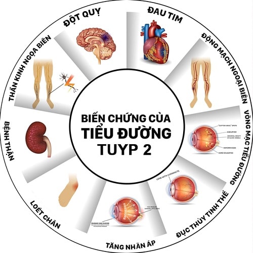 Tiểu đường tuýp 2 - Hình ảnh minh họa