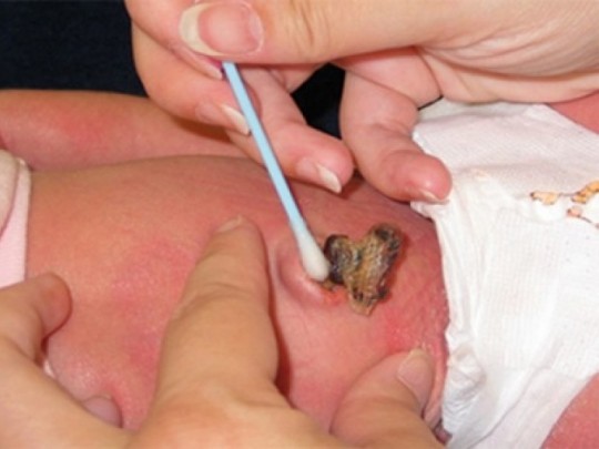 Tetanus - Hình ảnh minh họa