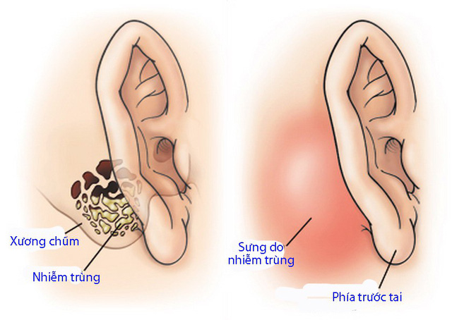 Tympanitis - Hình ảnh minh họa