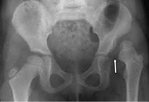 Trật khớp háng - Hình ảnh minh họa