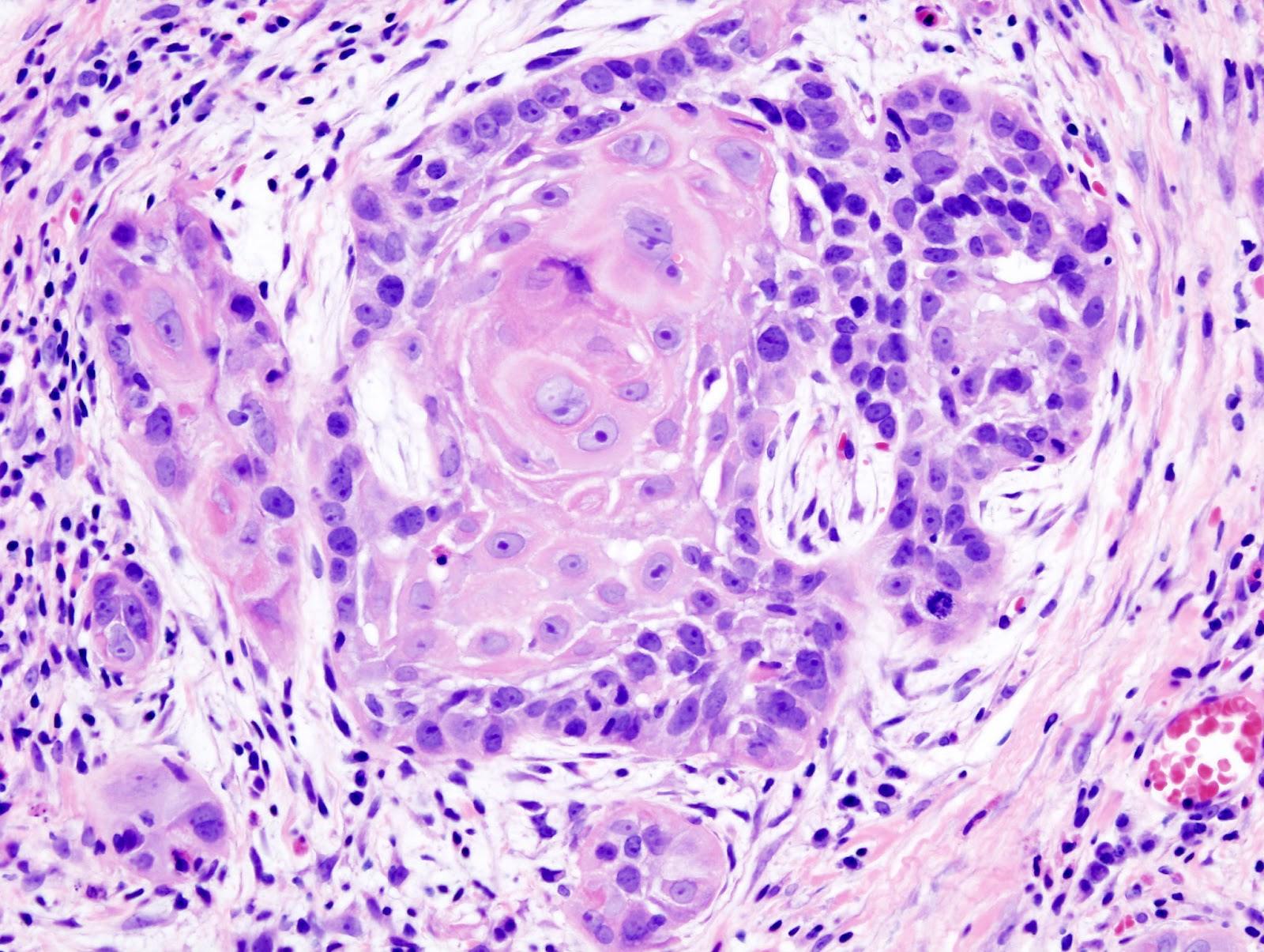 Squamous Cell Carcinoma - Hình ảnh minh họa