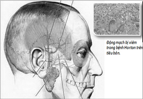 Temporal Arteritis - Hình ảnh minh họa