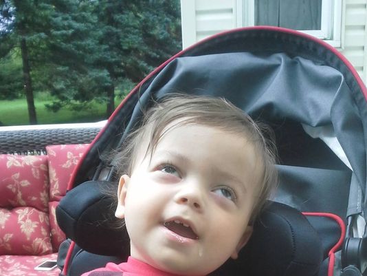 Tay-Sachs - Hình ảnh minh họa