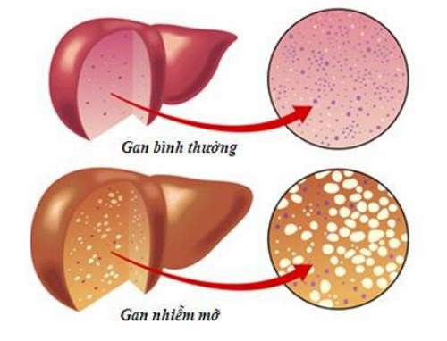 Gan nhiễm mỡ cấp độ 2 Những điều cần biết - ảnh 1