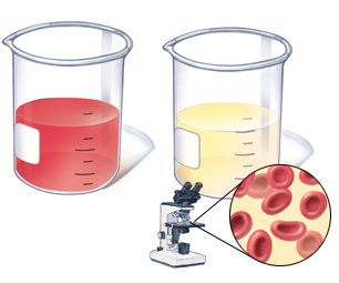 Tiểu máu - Hình ảnh minh họa