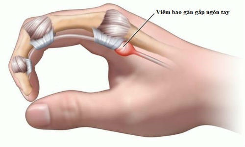 Tenosynovitis - Hình ảnh minh họa