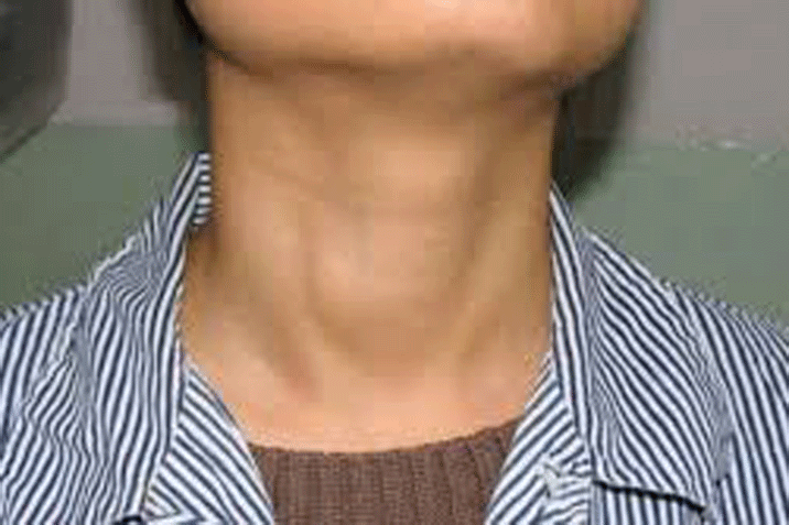 U nang tuyến giáp - Hình ảnh minh họa