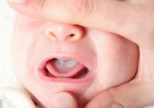 Tưa miệng - Hình ảnh minh họa